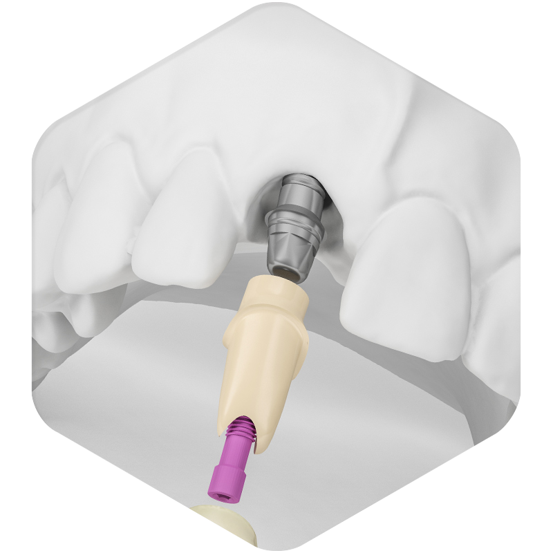 3D illustration of a dental implant.